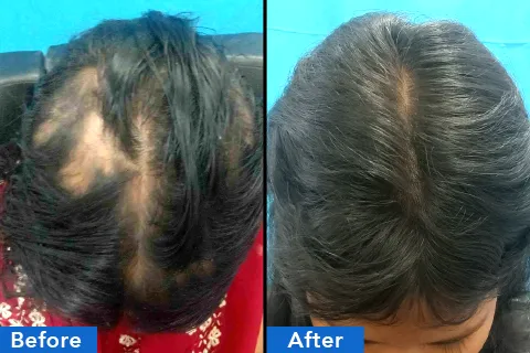 Hair treatments chennai